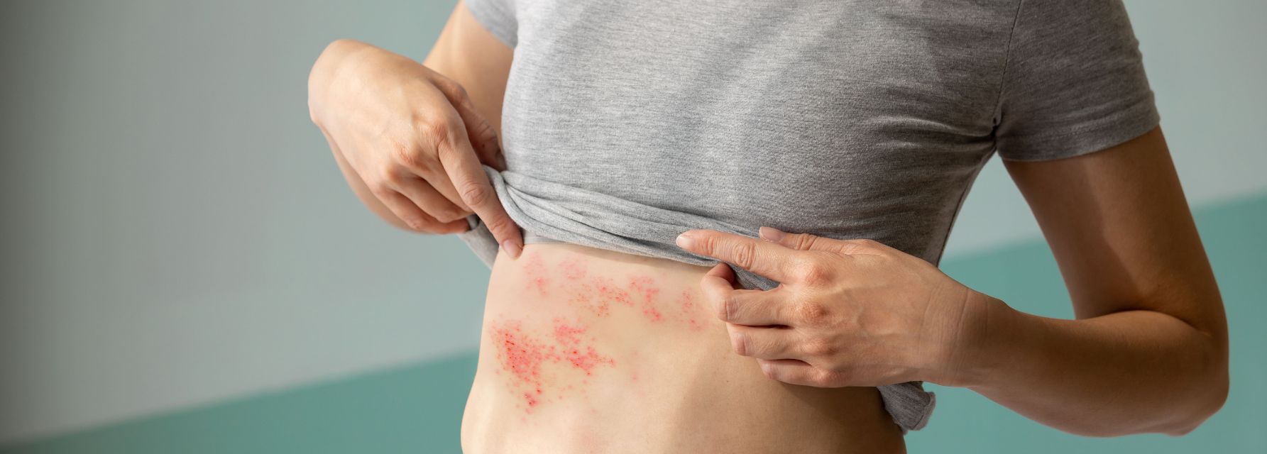 Los básicos del herpes zóster